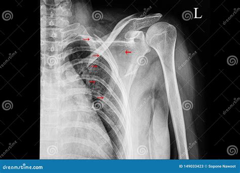 Scapula Fracture Radiology