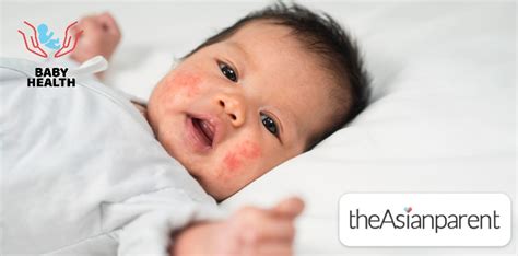 Baby Acne vs Eczema: What Are The Differences Between The Two