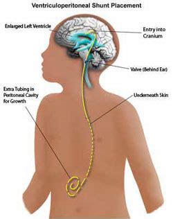 Hydrocephalus Scotland | What is a shunt?