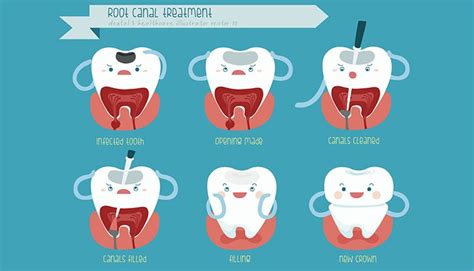 How To Stop Root Canal Pain - Most people do feel a little sensitive or ...