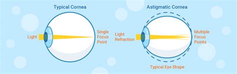 Are you astigmatic? Try our online astigmatism test to find out | Lentiamo