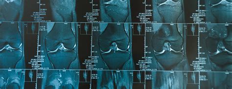 Knee MRI scan