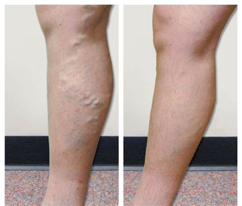 Varicose Veins - Vein Specialists of the Carolinas