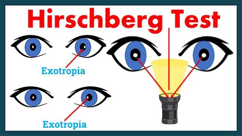 Hirschberg Corneal Reflex Test - A complete Tutorial. - YouTube