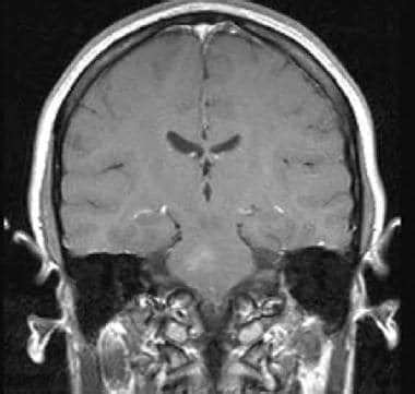 Capillary Telangiectasia Brain Imaging: Practice Essentials, Magnetic Resonance Imaging