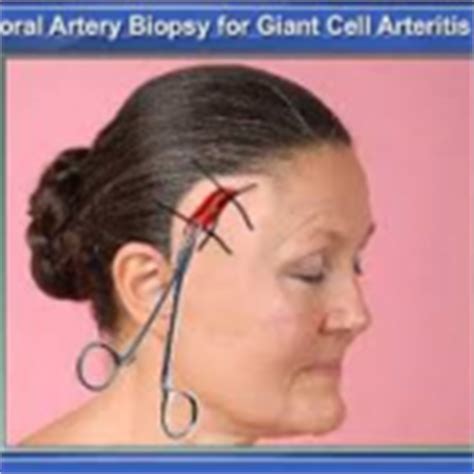 Temporal Artery Biopsy - Vascular Associates of Michigan Vascular ...