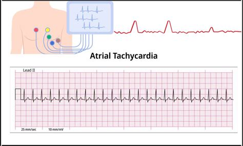 Atrial tachycardia: Causes, Risk Factors, Symptoms, Treatment