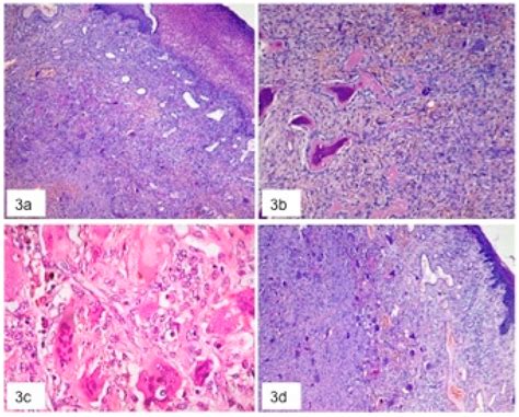 Peripheral Giant Cell Granuloma Histology