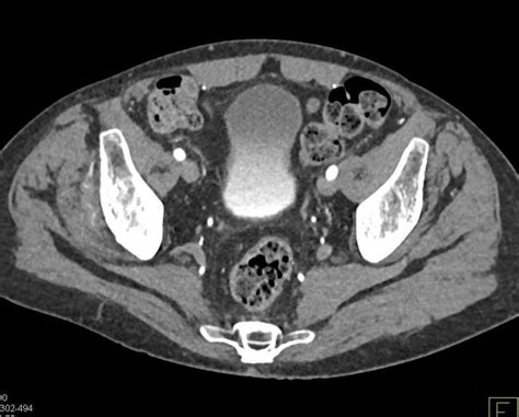 CT Urogram With Mild Medial Positioning of the Ureters / CTisus.com ...