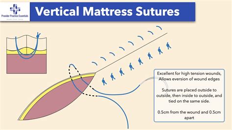 Wound Closure Techniques