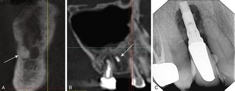 Dental Implant Intraoperative Complications | Pocket Dentistry