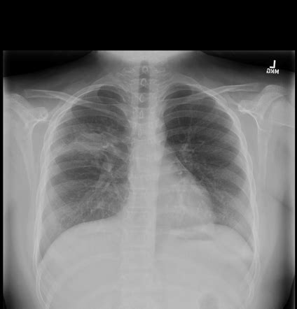 Blastomycosis Lung X Ray