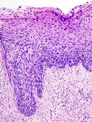 High-grade squamous intraepithelial lesion - Libre Pathology