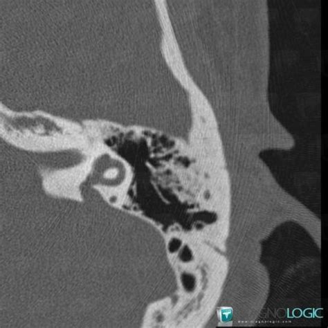 Radiology case : Enlarged vestibular aqueduct (CT) - Diagnologic