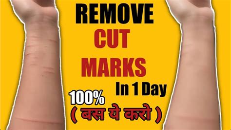 How To Remove CUT MARKS From Hand 100% ( Homemade Natural Remedy ...