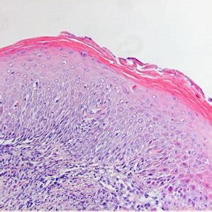 Photomicrograph showing a mucosal lesion for which no consensus could... | Download Scientific ...