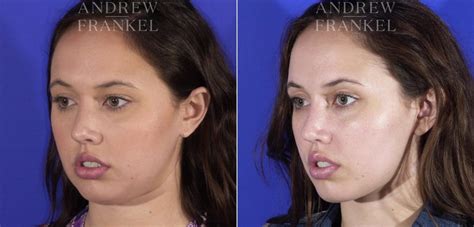 Buccal Fat Removal before and after photos - Andrew S. Frankel, MD