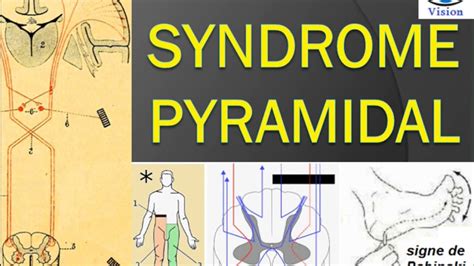 Pyramidalis Syndrome