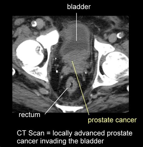 Prostate Imaging