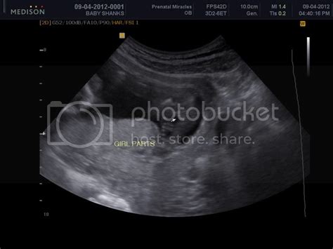 Baby girl Ultrasound photos - BabyCenter