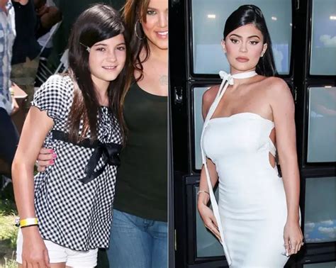 Kylie Jenner Before and After Plastic Surgery - Mayclinik