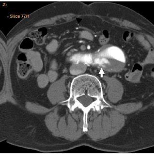 Axial computed tomography (CT) scan before endovascular aneurysm repair... | Download Scientific ...