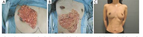 Figure 2 from Oncoplastic volume replacement technique for the upper inner quadrant using the ...