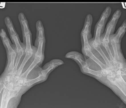 Ulnar Deviation X Ray