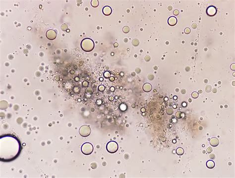 Microscopic View Of Stool Analysis Showing Neutral Fat Fecal Fat ...