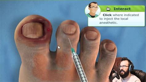 Ingrown Toenail Removal Surgery - YouTube