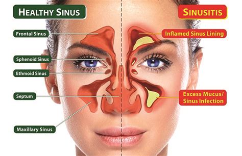 01/25/2017 - Straightening Out Your Sinuses