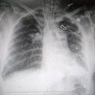 Chest X ray: fibrosis of left lung; right, middle and lower zone... | Download Scientific Diagram