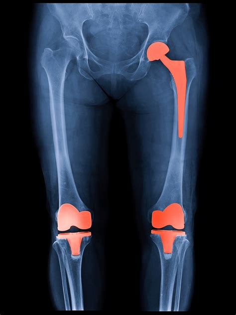 How long will my hip or knee replacement last? - Harvard Health