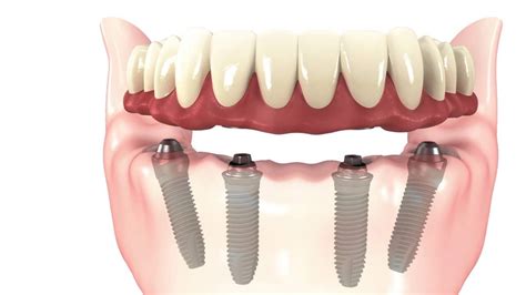 Lasting Smile With All-on-4 Dental Implants | Northlake Charlotte ...