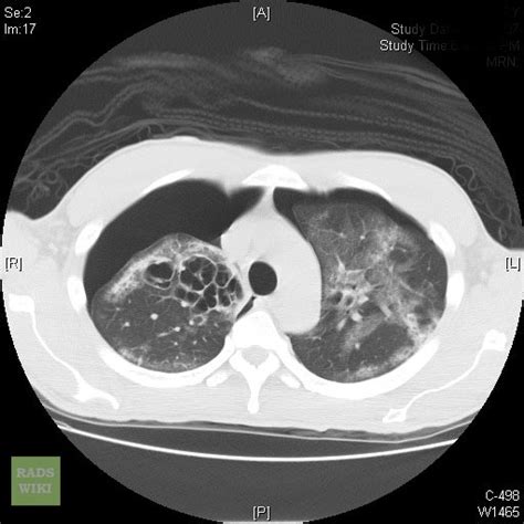 Pneumothorax CT - wikidoc