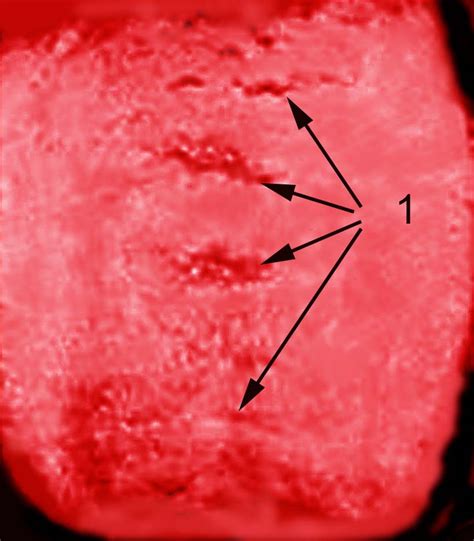 Ocular Pathology: What is Melkersson-Rosenthal syndrome?