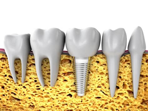 Bone Regeneration for Dental Implants - Vero Implants & Periodontics