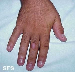 Knuckle Pads – Causes, Symptoms, Pictures and Treatment | Healthhype.com