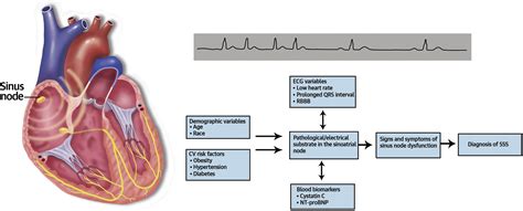 Demystifying Sick Sinus Syndrome