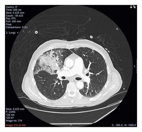 CT pulmonary angiogram report: there are no pulmonary emboli and... | Download Scientific Diagram