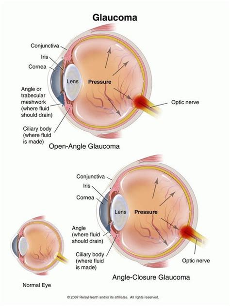 Glaucoma a leading cause of blindness