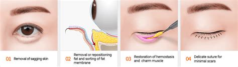 Eye Bag Removal Surgery For The Elderly: Is It Recommended? | Dream Plastic Surgery