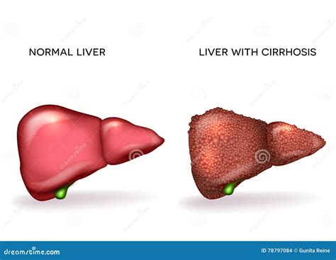 Normal Healthy Liver and Liver with Cirrhosis Stock Vector - Illustration of human, gallbladder ...