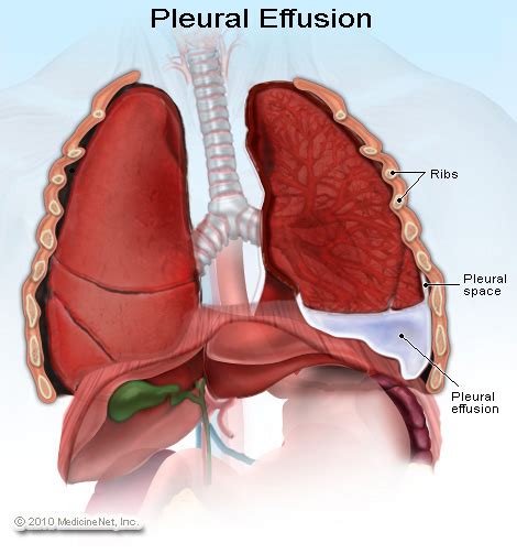 What Is Pleurisy? Symptoms diagnosis and treatment | LaTeSt TeChNoLoGy NeWs