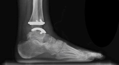 Ankle Replacement Recovery Made Easy : Phoenix Foot and Ankle Institute ...