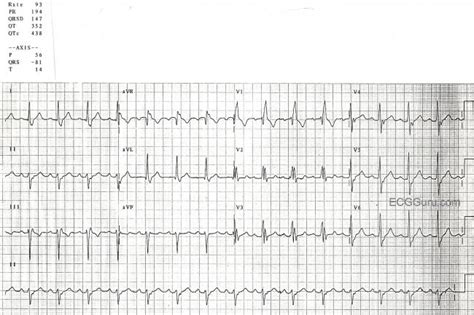 Left anterior hemiblock | ECG Guru - Instructor Resources