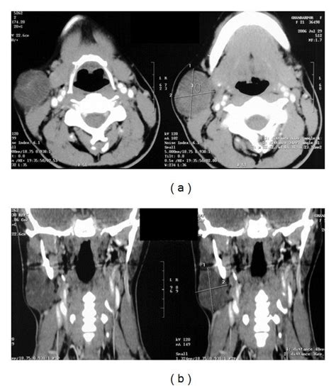 Contrast-enhanced CT scan in axial views of neck. A 36 × 48 mm soft ...