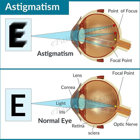 Astigmatism | Eye facts, Stigmatism eye, Astigmatism