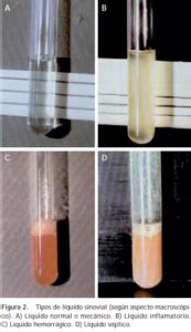 ANÁLISIS DEL LÍQUIDO SINOVIAL - EduLabC