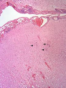 Pathology Outlines - Herpes simplex encephalitis